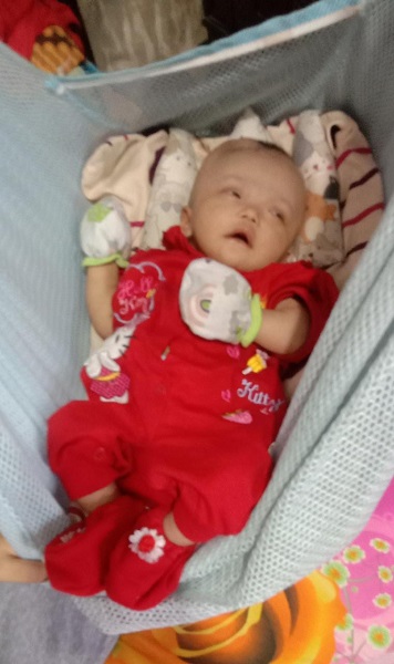 Bayi Penderita Hidrosefalus Di Langsa Butuh Bantuan