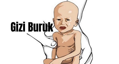Balita Panyabungan Diduga Gizi Buruk Meninggal Dunia