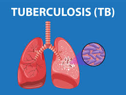 3.883 Kasus TB/TBC Di Kota Medan Sedang Diobati