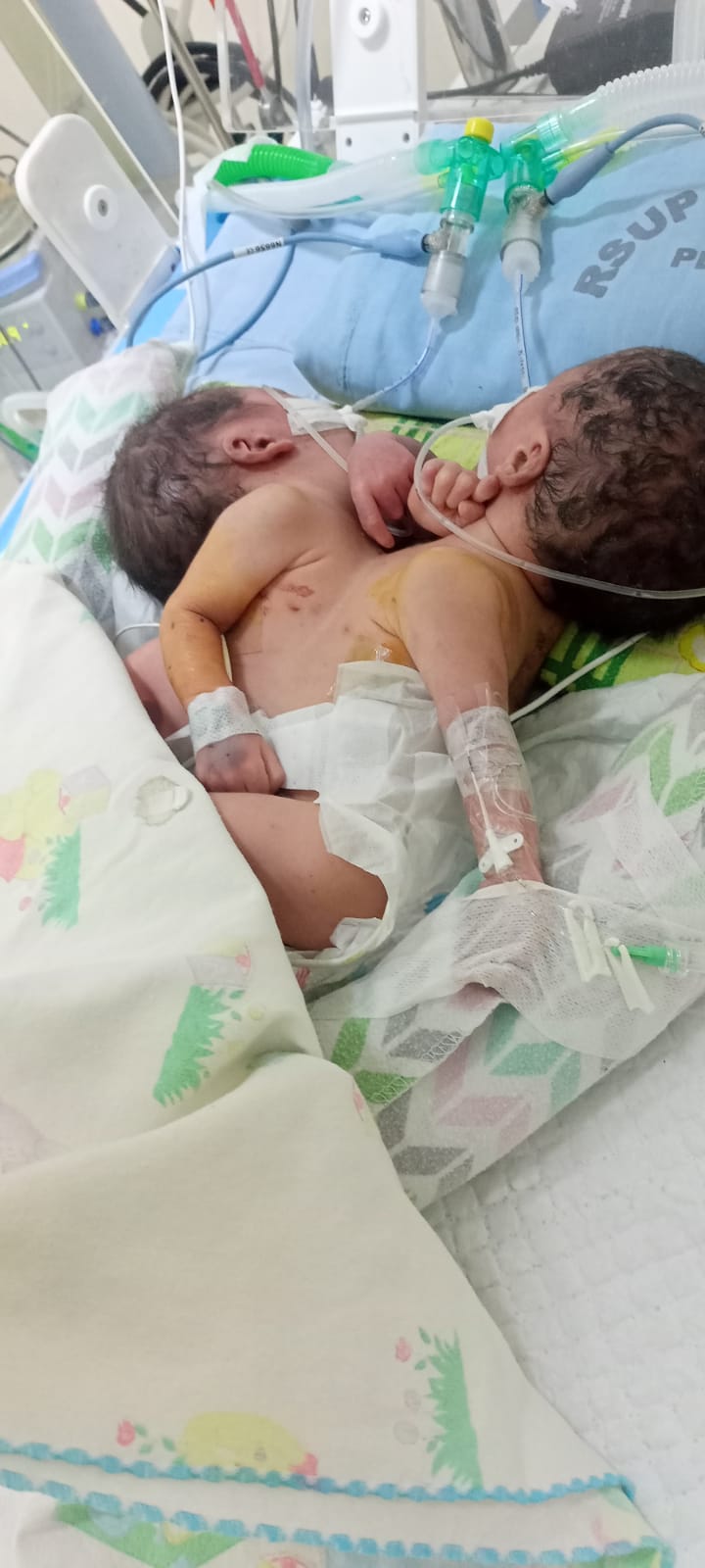 Lahirkan Bayi Kembar Siam, Warga Batubara Mohon Bantuan Di RSUP Adam Malik Medan