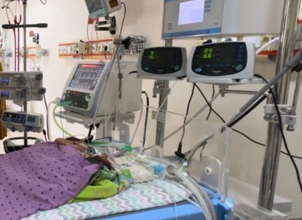 Bayi Kembar Siam di RSUP HAM Butuh Donor ASI