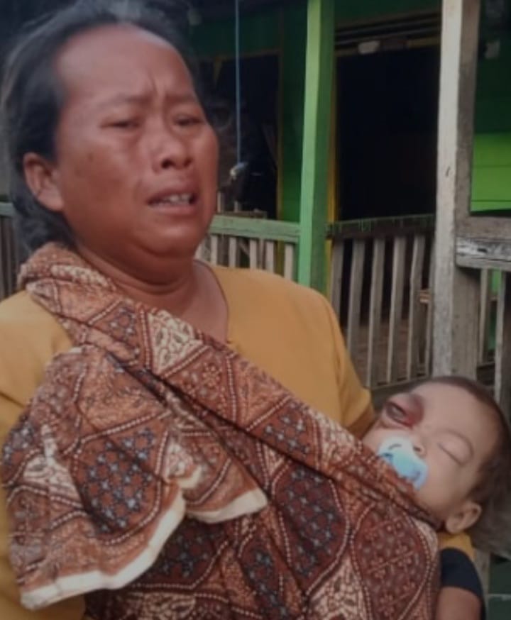 Alifah Balita Di Tanjungtiram Harapkan Pengobatan