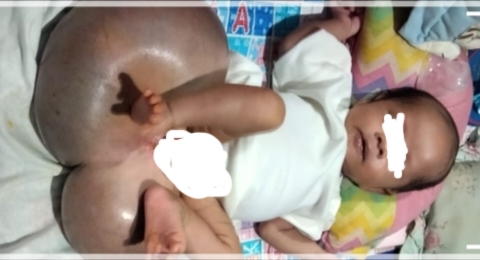 Bayi Penderita Spina Bifida, Butuh Bantuan Dermawan