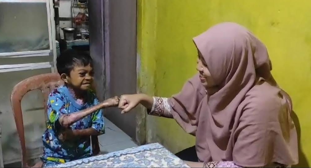 Dapat Perhatian Mensos, Remaja 17 Tahun Asal Seram Utara Penderita Kelainan Kulit Berobat ke RSCM