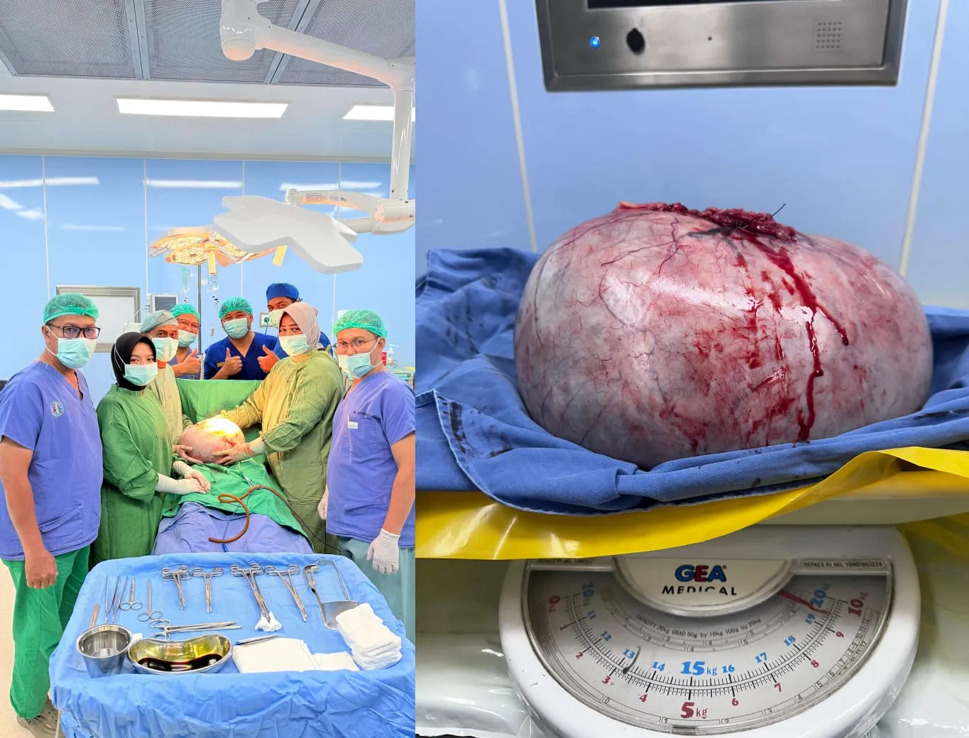 Tim Dokter RSUDYA Tapaktuan Berhasil Angkat Kista Ovarium Raksasa Seberat Lebih dari 19 Kilogram