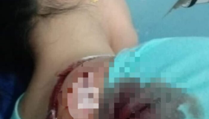 Wanita Terkapar Kena Clurit Begal di Jl. Cemara Abadi