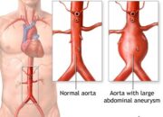 Pembengkakan Aorta Dapat Sebabkan Konsekuensi Serius Jika Tidak Ditangani