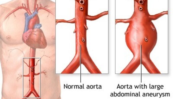 Pembengkakan Aorta Dapat Sebabkan Konsekuensi Serius Jika Tidak Ditangani