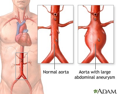 Pembengkakan Aorta Dapat Sebabkan Konsekuensi Serius Jika Tidak Ditangani