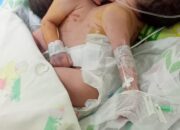 Lahirkan Bayi Kembar Siam, Warga Batubara Mohon Bantuan Di RSUP Adam Malik Medan