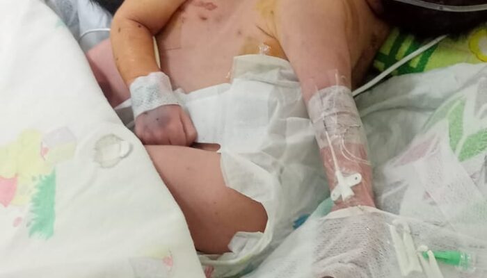 Lahirkan Bayi Kembar Siam, Warga Batubara Mohon Bantuan Di RSUP Adam Malik Medan