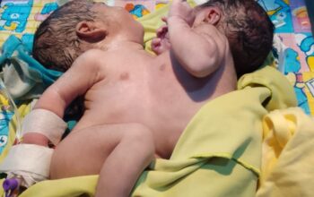 Bayi Kembar Siam Asal Lebak Dirujuk Ke RSCM