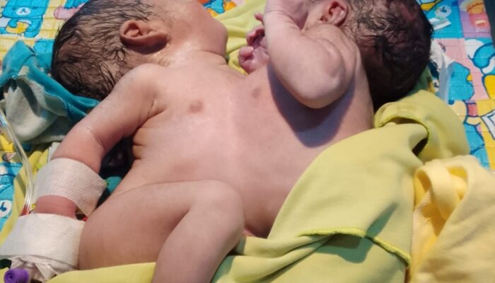 Bayi Kembar Siam Asal Lebak Dirujuk Ke RSCM