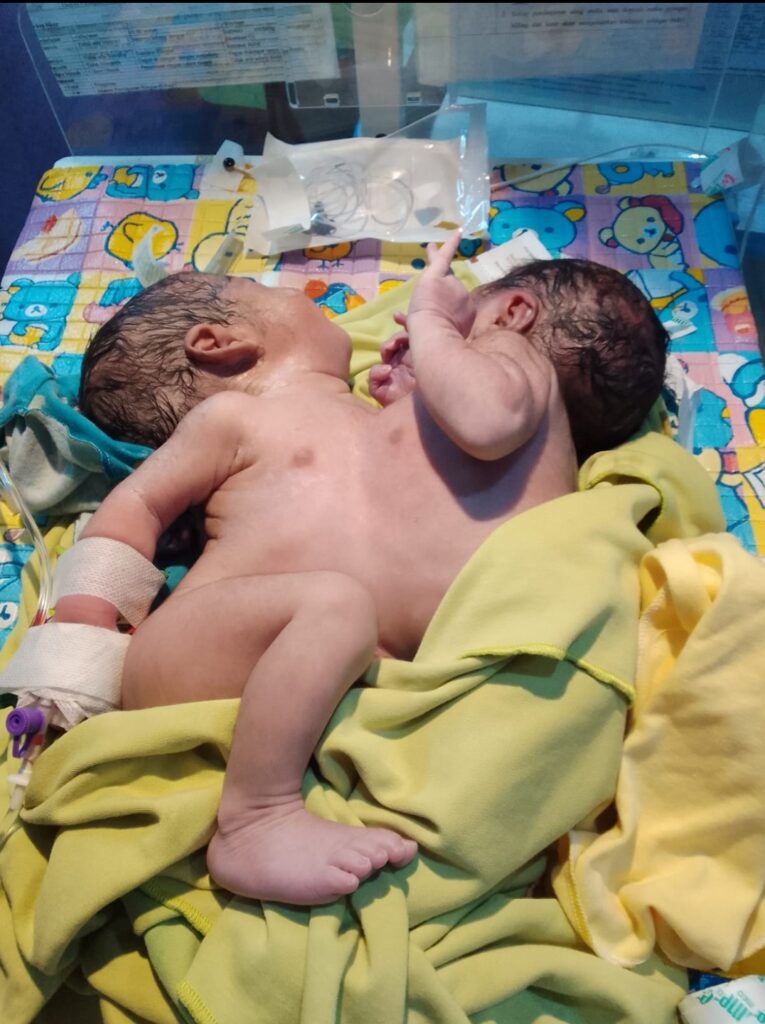 Bayi Kembar Siam Asal Lebak Dirujuk Ke RSCM