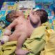 Bayi Kembar Siam Asal Lebak Dirujuk Ke RSCM