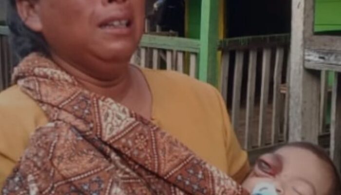 Alifah Balita Di Tanjungtiram Harapkan Pengobatan