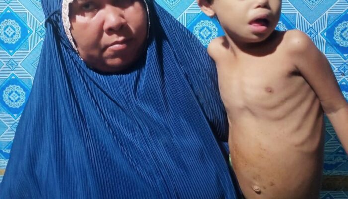 Bocah Penderita Jantung Bocor Segera Diterbangkan Ke Jakarta