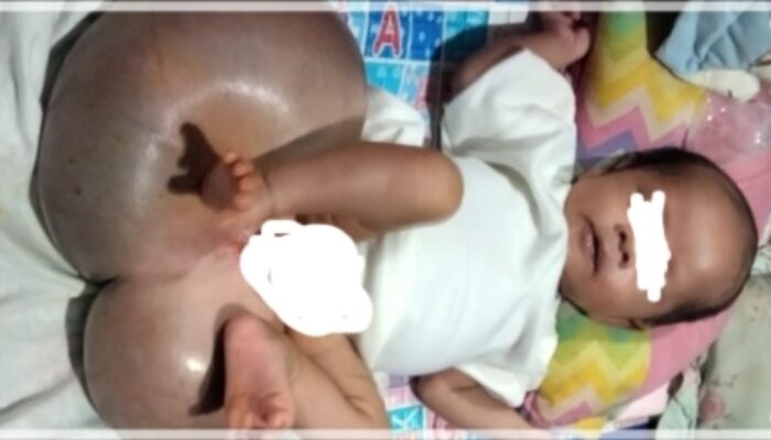 Bayi Penderita Spina Bifida, Butuh Bantuan Dermawan