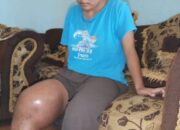Penderita Kaki Bengkak Akibat Tumor Meninggal Dunia