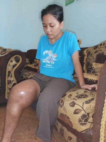 Nabila Zahra Lubis, 16, warga Desa Tangga Bosi, Kecamatan Lubuk Barumun, Kabupaten Padanglawas, penderita kaki bengkak akibat tumor akhirnya meninggal dunia.(Waspada/Idaham Butar Butar)