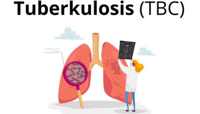 Keberhasilan Pengobatan TBC Di Sumut mencapai 90,2%