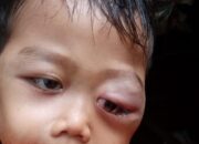 Balita Penderita Mata Bengkak Butuh Bantuan