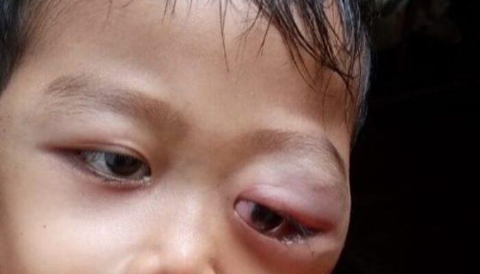 Balita Penderita Mata Bengkak Butuh Bantuan