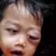 Kondisi Ahmad Zaini Hasibuan, anak bayi lima tahun dari keluarga kurang mampu saat pemeriksaan awal. Waspasa/Ist