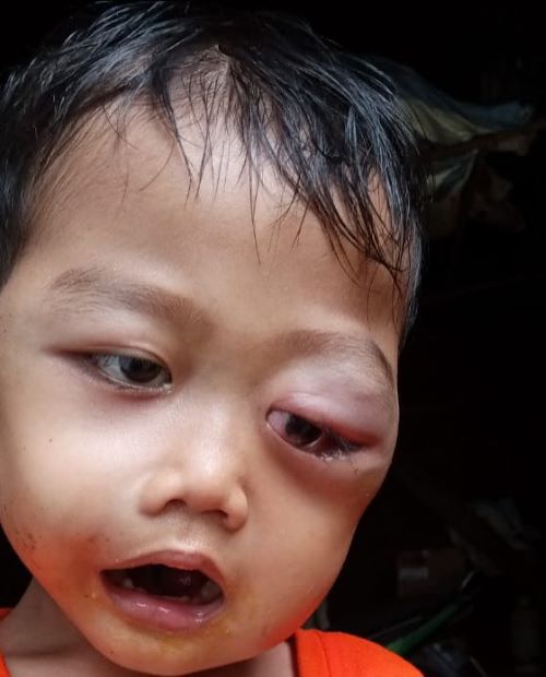Kondisi Ahmad Zaini Hasibuan, anak bayi lima tahun dari keluarga kurang mampu saat pemeriksaan awal. Waspasa/Ist