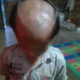 KEPALA bagian atas pelajar JS yang botak akibat dicukur gurunya. Waspada/Ist