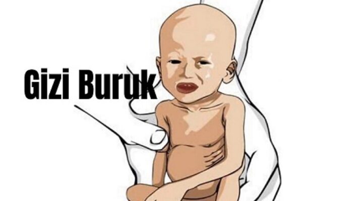 Balita Panyabungan Diduga Gizi Buruk Meninggal Dunia