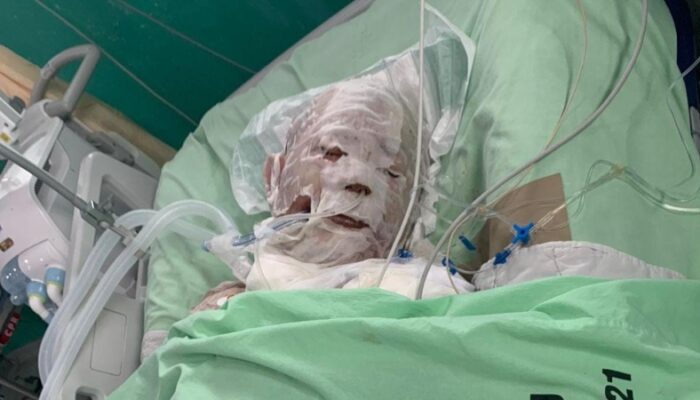 Korban Ledakan Gas Bumi PGN Akhirnya Meninggal Dunia