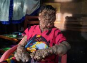 Tubuh Penuh Benjolan, Warga Paluta Ini Butuh Bantuan