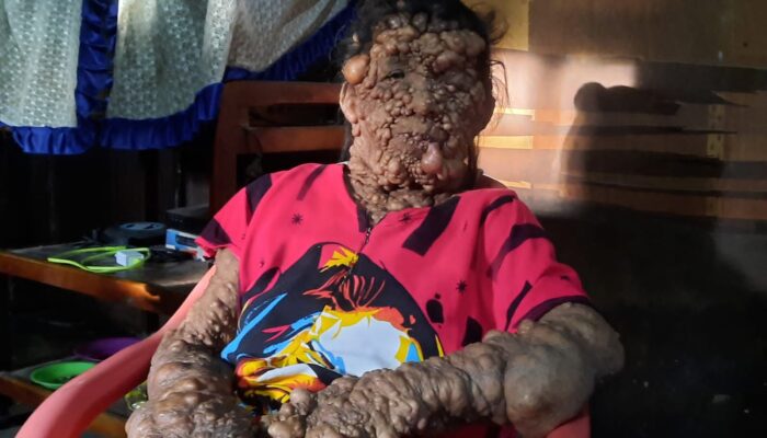 Tubuh Penuh Benjolan, Warga Paluta Ini Butuh Bantuan