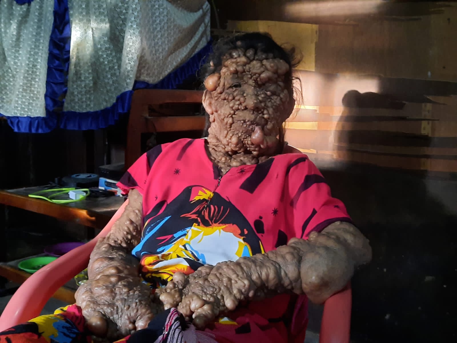 Tubuh Penuh Benjolan, Warga Paluta Ini Butuh Bantuan