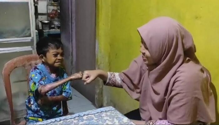 Dapat Perhatian Mensos, Remaja 17 Tahun Asal Seram Utara Penderita Kelainan Kulit Berobat ke RSCM