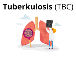 Dinkes Medan Catat Tuberkulosis Di Sumut Capai 49 Ribu Lebih Kasus