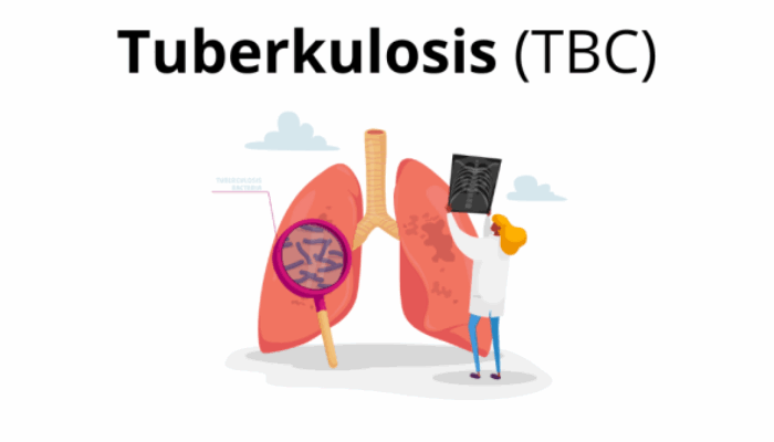 Dinkes Medan Catat Tuberkulosis Di Sumut Capai 49 Ribu Lebih Kasus