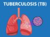 Tuberkolosis. Waspada/ist
