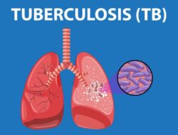 Kasus TB Di Sumut Baru Terdeteksi 45 Persen