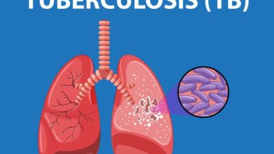 Kasus TB Di Sumut Baru Terdeteksi 45 Persen