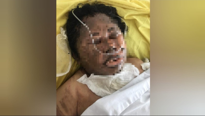 HERLINDA Boru Gurusinga, 53, menjalani perawatan di Jl. RS Haji, Desa Medan Estate, Kecamatan Percut Seituan, Kabupaten Deliserdang, Senin (13/5), setelah dibakar oleh pria berinisial SP alias Leman, 51. Waspasa/ist