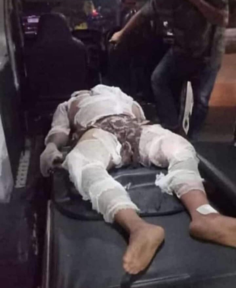 SEORANG pekerja yang menderita luka bakar serius saat hendak dievakuasi ke rumah sakit terdekat usai terjadi kebakaran akibat ledakan tabung gas oplosan di Dusun III Gang Mandor Jono Desa Sei Rotan Kecamatan Percut Seituan, Kamis (23/5) pukul 22:00. Waspada/Ist