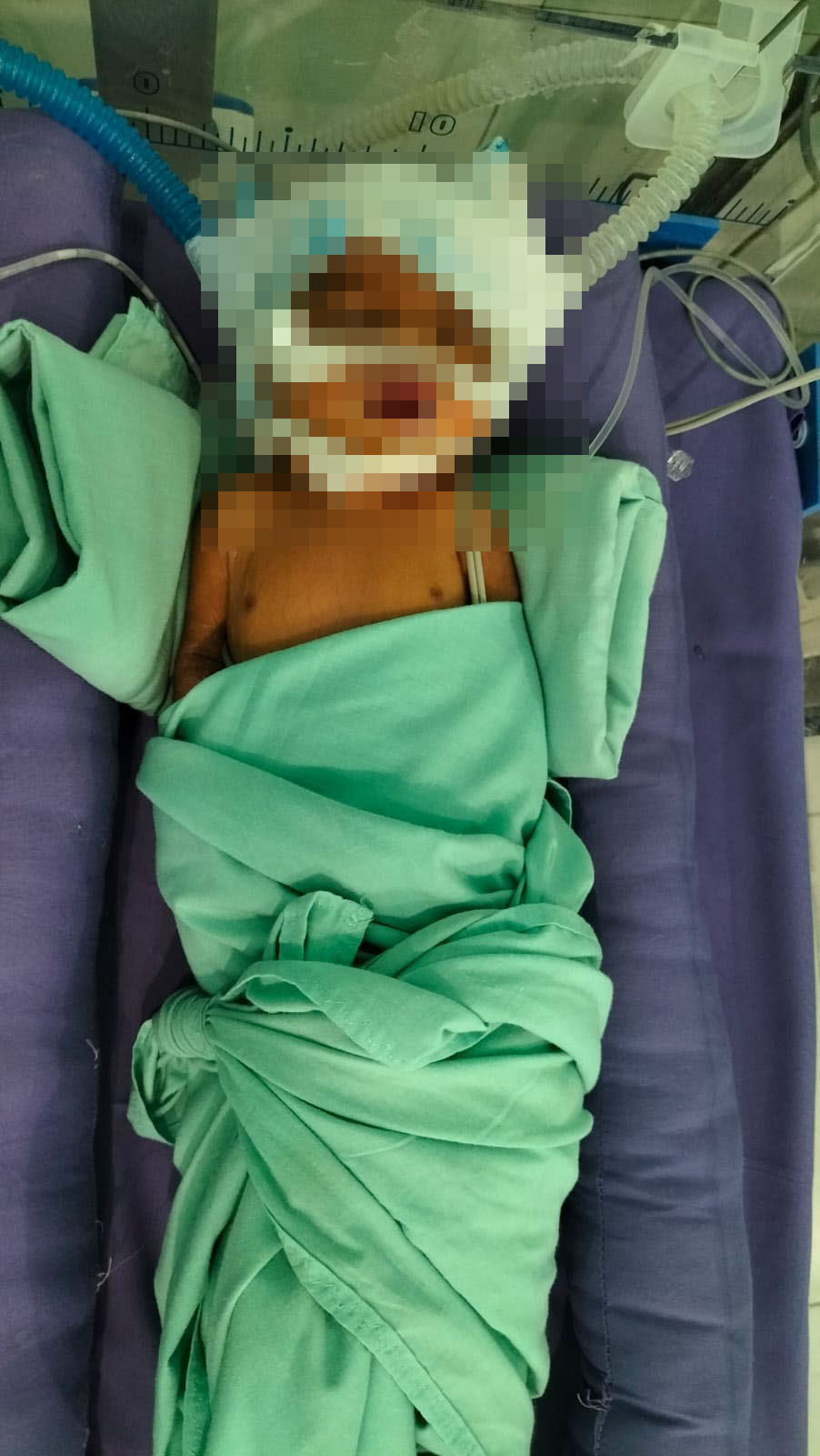 Kondisi bayi malang yang kini mendapatkan perawatan di ruang bayi pada RSUD Langsa dengan kondisi kian stabil dan membaik, Senin (6/5). Waspada/Rapian.