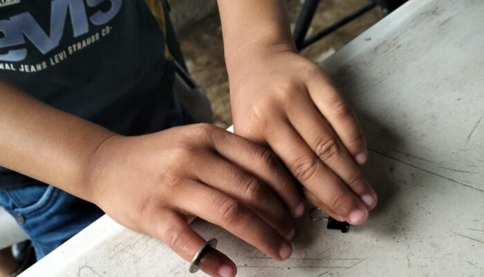 Ada-ada Saja, Bocah Masukkan Ring Baut Ke Jari Kelingking