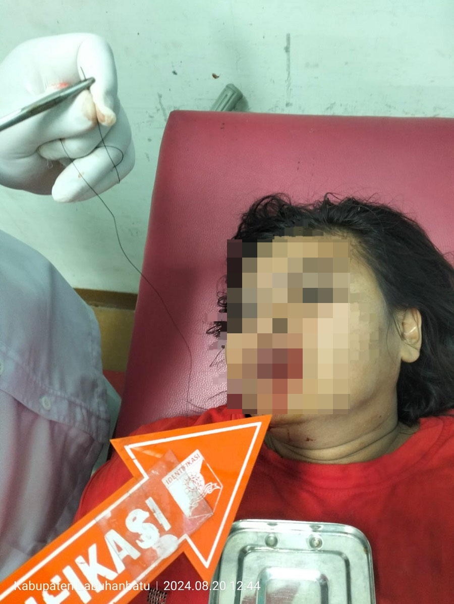 Korban RY saat dirawat di RSUD Rantauprapat. (Waspada/Ist)