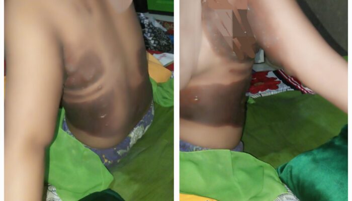 Sekdes Di Sidimpuan Bakar Teman Wanita Karena Cemburu