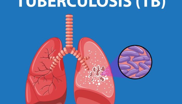 Tuberkulosis Di Sumut Capai 18.411 Kasus, Dinkes Sumut Dorong Perilaku Hidup Bersih dan Sehat