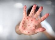 Kasus Campak Di Medan Meningkat Drastis