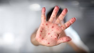 Kasus Campak Di Medan Meningkat Drastis